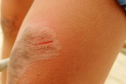 When a Wound Doesn't Heal: Understanding Chronic Wound Infection