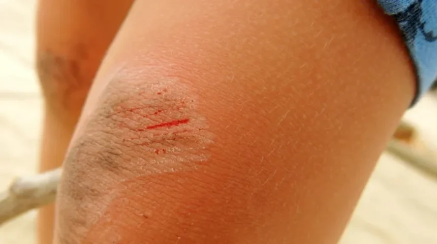 When a Wound Doesn't Heal: Understanding Chronic Wound Infection